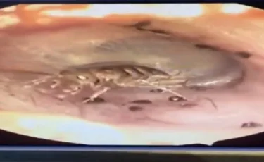 Дәрігерлер ер адамның құлағынан тірі шегірткені алып шықты (видео)