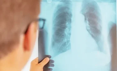 Түркістан облысында 102 адам туберкулез жұқтырған