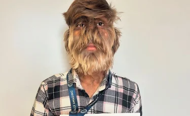 Самое волосатое лицо в мире: 18-летний парень вошел в Книгу рекордов Гиннесса