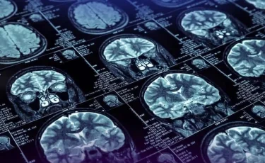 Жыл сайын 40 мың адам инсультке шалдығады