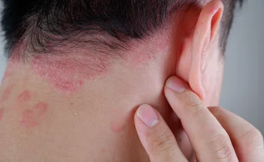 В Алматы наблюдается рост кожных заболеваний