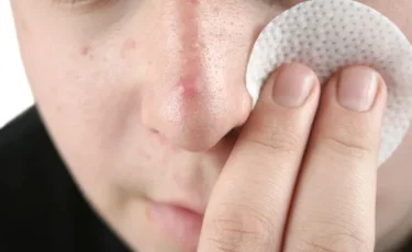 Мұрындағы безеуді неге сықпау керек – дәрігер кеңесі