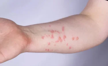 В Гане зафиксировали резкий скачок оспы обезьян