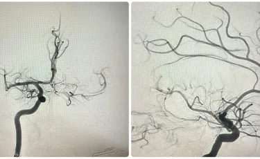 Искусственный интеллект помогает врачам спасать жизни при инсультах
