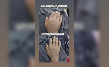 Своевременная реабилитация: как пенсионерка восстановилась после тяжелого инсульта