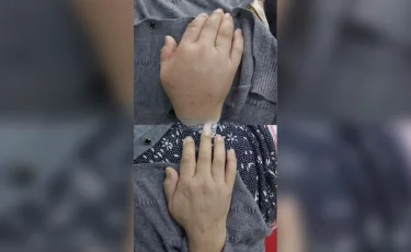 Инсульт алған науқас №7 қалалық ауруханада қалай сауықты