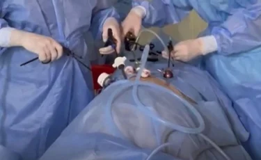 Лапароскопическое ушивание перфоративной язвы: современный подход в экстренной хирургии