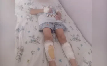 Денесін үтікпен күйдірген: анасынан зәбір көрген балалар ауруханада жатыр