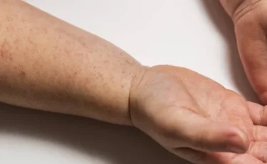 Қызылша өсімі байқалған 9 өңірде қосымша иммундау жұмысы күшейтілді