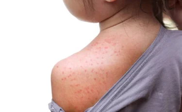 Вспышка кори в Казахстане: главный санврач ввела новые меры