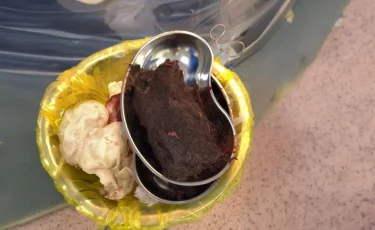 Түркістанда 15 жастағы қыздың асқазанынан салмағы 900 грамм шаш шықты