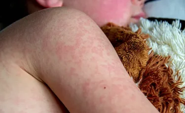 Қызылшаның салдары қандай - дәрігерлер ескертеді