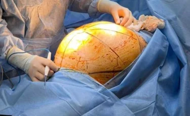 Долго скрывала болезнь: в Алматы пациентке удалили гигантскую опухоль