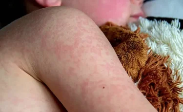 Қызылша: Павлодар облысында 67 адам жұқтырған