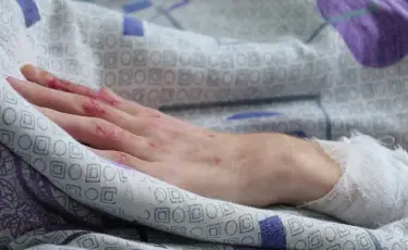 Өліммен арпалысқан ай: 27 мың вольттық тоққа түскен жасөспірімге 18 ота жасалды