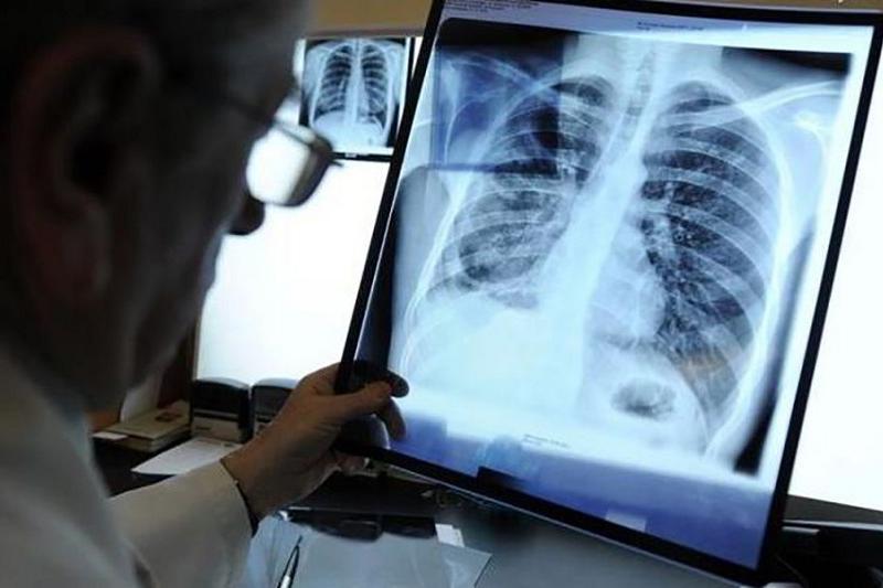 6 человек с тяжелой формой туберкулеза разыскивают в ВКО
