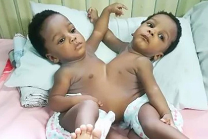 13 часов и 78 медработников. В столице Нигерии успешно разделили сиамских близнецов