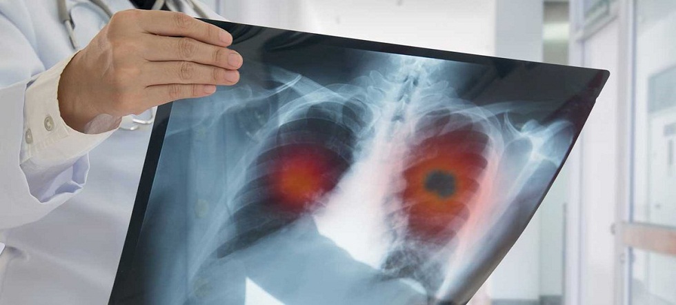 В Казахстане за прошедшие сутки 3 человека скончались от пневмонии