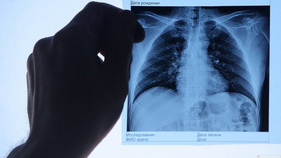 В Казахстане за сутки выявили 229 случаев заболевания пневмонией