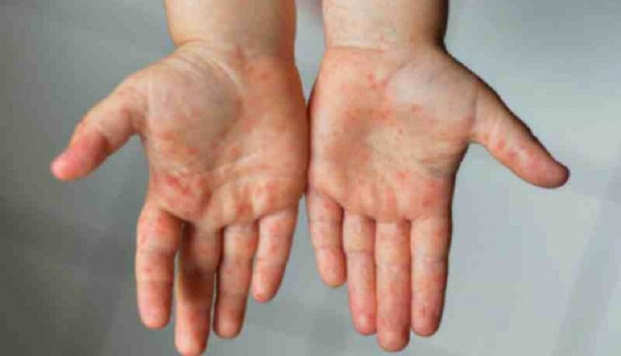 Синдром Кавасаки может появиться у детей, переболевших COVID-19 в бессимптомной форме  