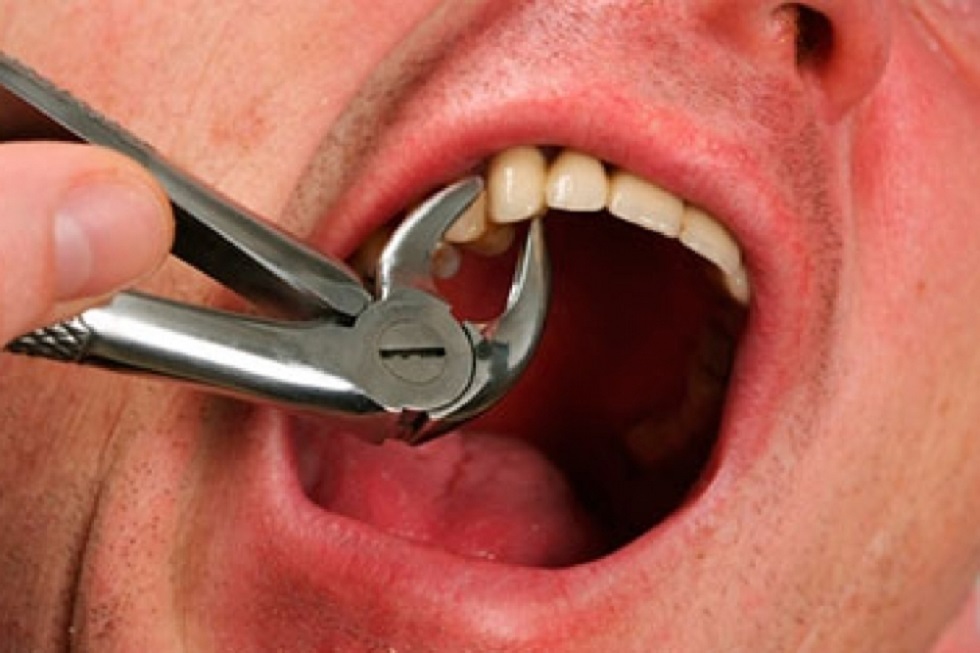 Пациент вырвал зубы плоскогубцами, чтобы попасть в стоматологию