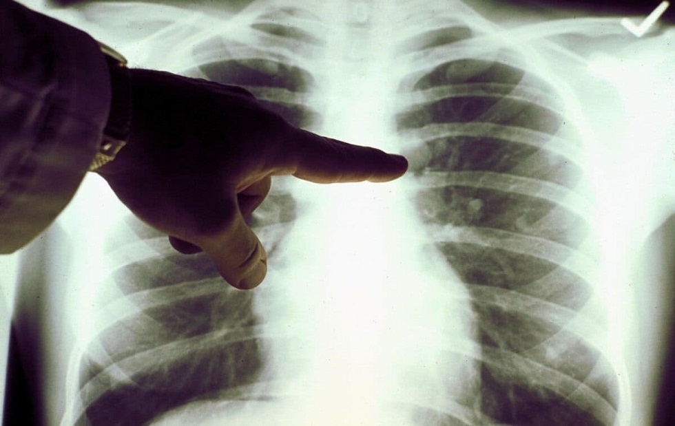 Коронавирусная пневмония: еще 165 случаев выявлены за сутки