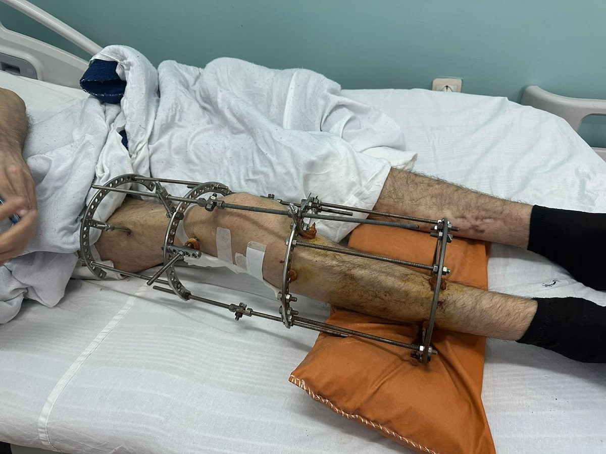 Сразу три операции: Ортопеды ЦГКБ спасли пациента от инвалидности